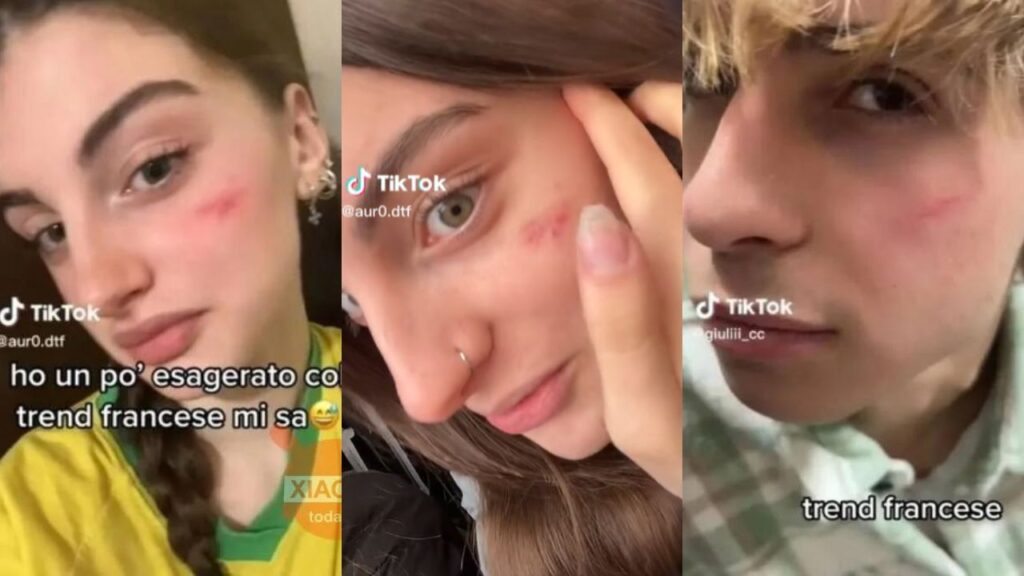 italia cicatriz-francesa